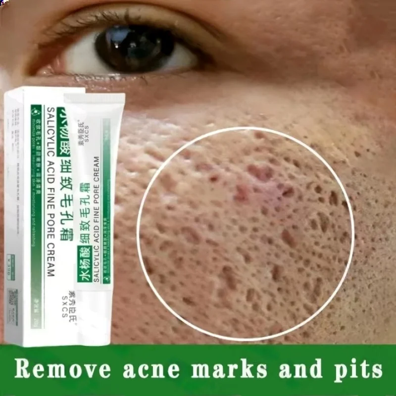 Azelaic Acid Cream - Crema per la pulizia dei pori