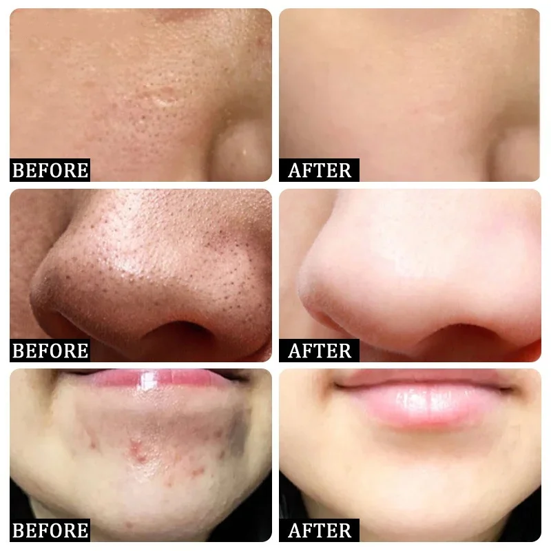 Crema per la pulizia dei pori  - Azelaic Acid Cream recensione e prezzo