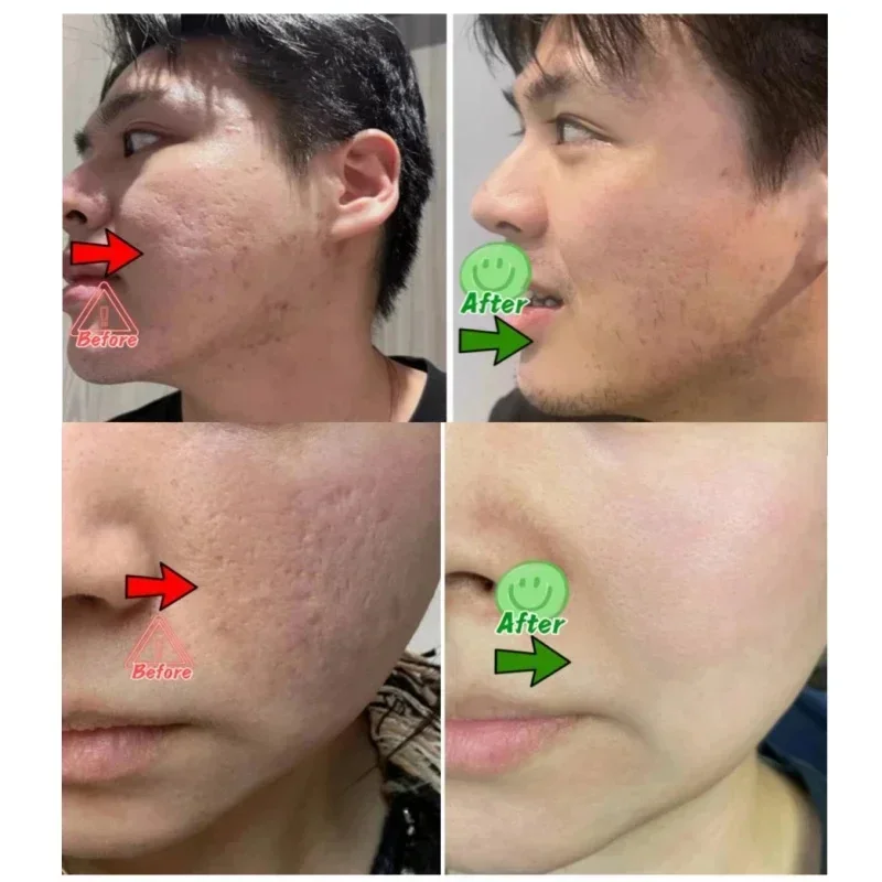Crema per la pulizia dei pori  - Azelaic Acid Cream recensione e prezzo