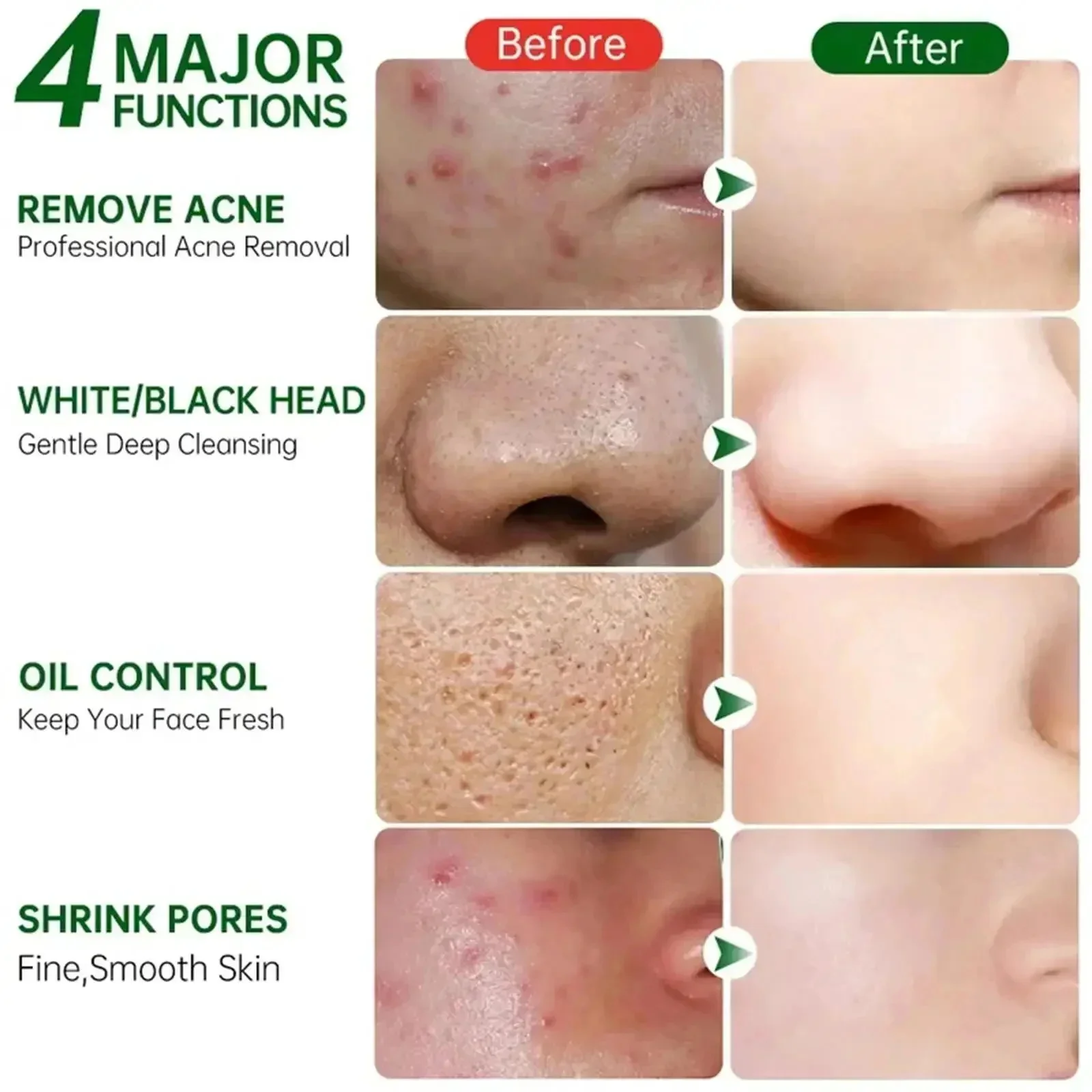 Crema per la pulizia dei pori  - Azelaic Acid Cream recensione e prezzo